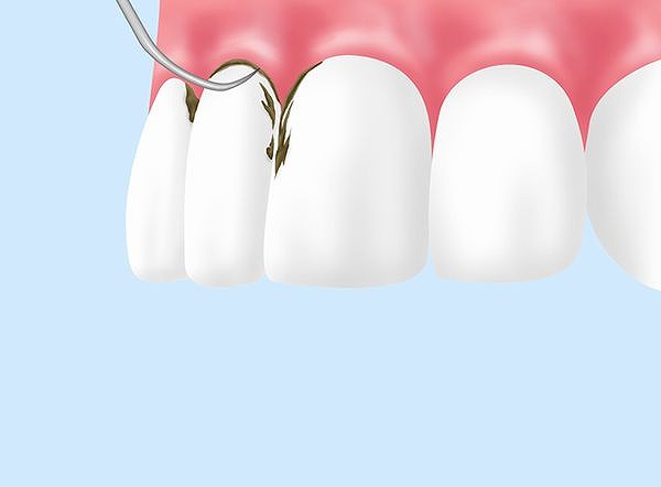 スケーリング・ルートプレーニング